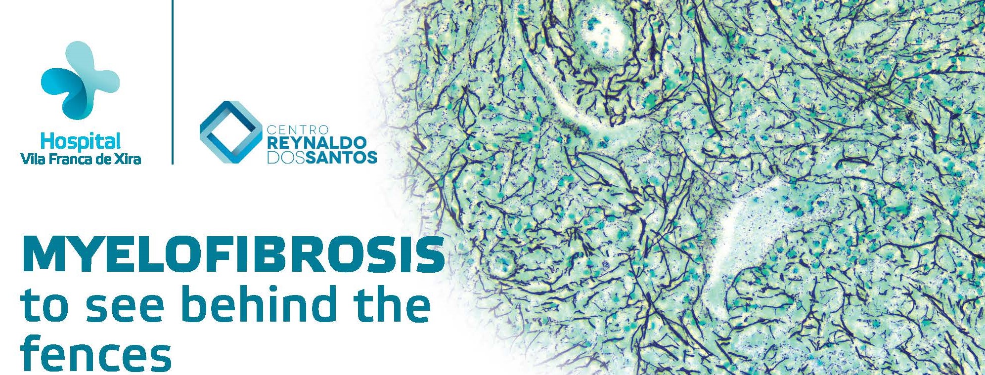 hospital-de-vila-franca-de-xira-Myelofibrosis To See Behind The Fences